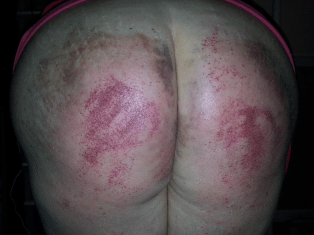 A bare bottom, extremely bruised and red.